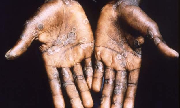 GHS confirms Monkeypox case, 230 suspected cases across 88 districts